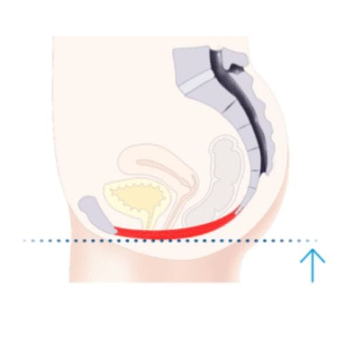 EMsella Chair - after - pelvic floor - define aesthetics - Sue West RN - kegel throne