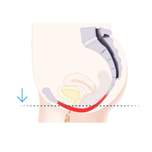 before pelvic floor emsella chair - Define Aesthetics kegel throne
